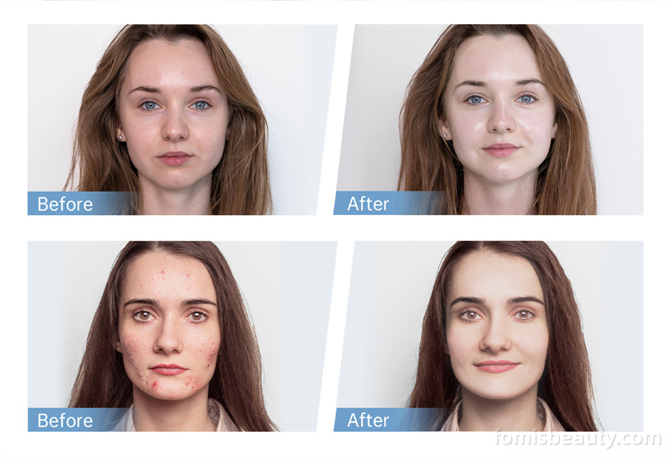 Cardtridge of Hydra Pen H5 Device for Face Nano Microneedle Technology & Mesotherapy for Skin Rejuvenation & Anti-Aging - 图片 4