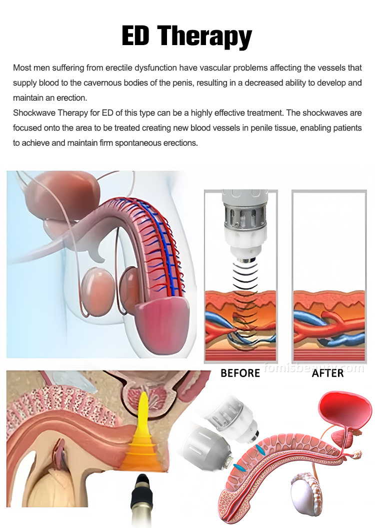2 IN 1 Dual Wave Shock Wave Therapy Machine Professional Physio Equipment for Clinics Musculoskeletal Pain Relief & ED Treatment - 图片 3